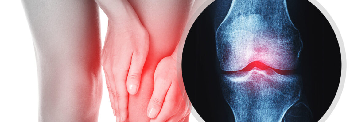 8-Day Osteoarthritis Joint Care & Mobility Program