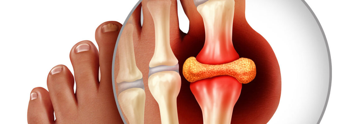 Gouty Arthritis (Vatarakta) Ayurvedic Detox & Joint Recovery Program